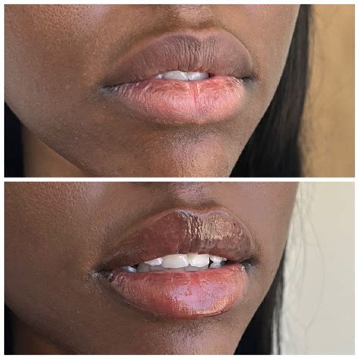 Achieve Plumper Lips With Expert Lip Injections In Santa Barbara