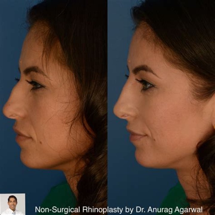 Affordable Non-Surgical Rhinoplasty: Discover Affordable Prices