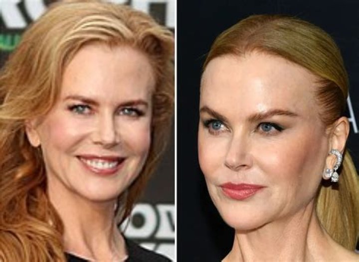Nicole Kidman's Plastic Surgery: The Ultimate Guide