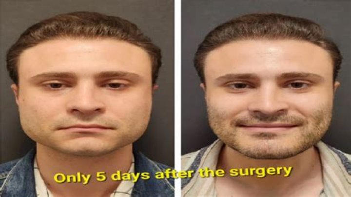 The Ugly Truth: Double Jaw Surgery Gone Horribly Wrong